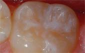 Pediatric Dentist - Tooth After Sealant Application